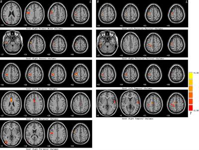 Enhanced Connectivity of Thalamo-Cortical Networks in First-Episode, Treatment-Naive Somatization Disorder